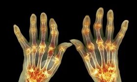 Wat is het verschil tussen artritis van artrose van de gewrichten