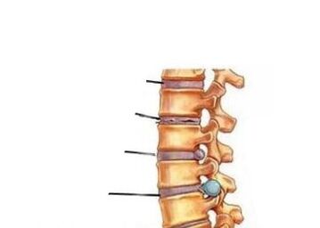 Vier stadia van ontwikkeling van osteochondrose